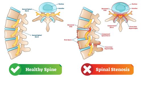 image contrasting a healthy spine with a spine having spinal stenosis