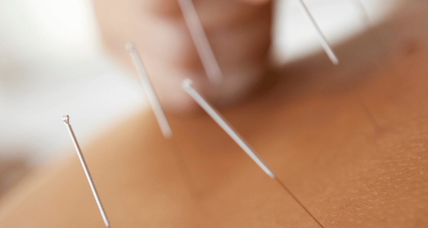 How Acupuncture Helps with Chronic Pain